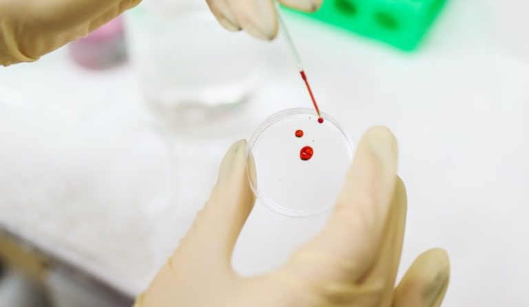 L Hiv Si Vede Dalle Analisi Del Sangue